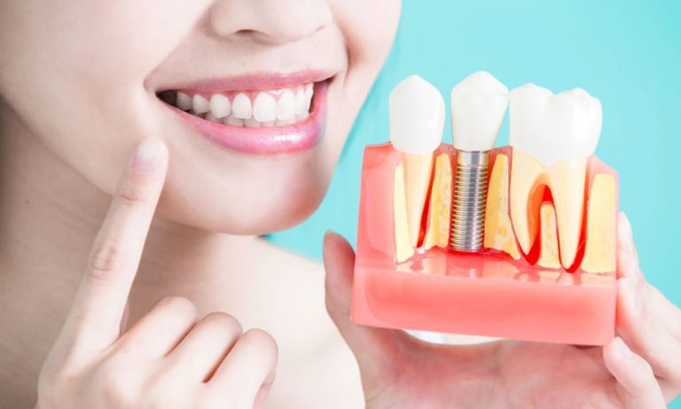 ماذا تعرف عن أنواع زراعة الأسنان في نفس اليوم؟